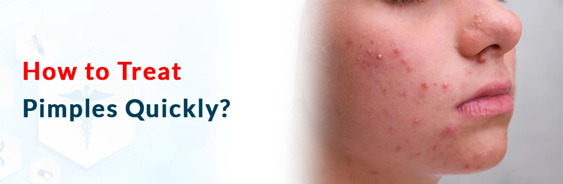  How to Treat Pimples Quickly?